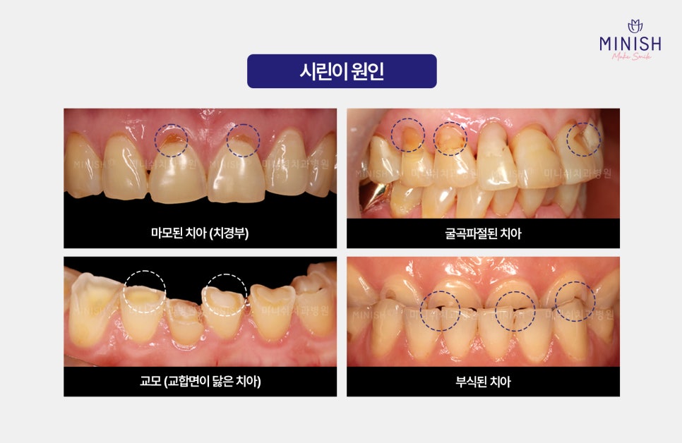 시린이 치료로 주목받는 미니쉬! 관련 이미지 2