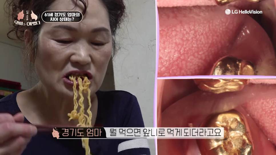 [Tooth Aging] Do Teeth Age, Too? Restoring Them Healthily with Minishe image 3
