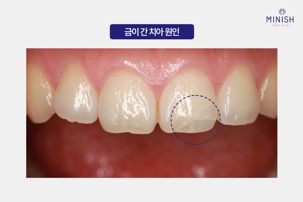 Cracked Teeth, from Cause to Treatment! How to Regain Healthy Teeth image 2