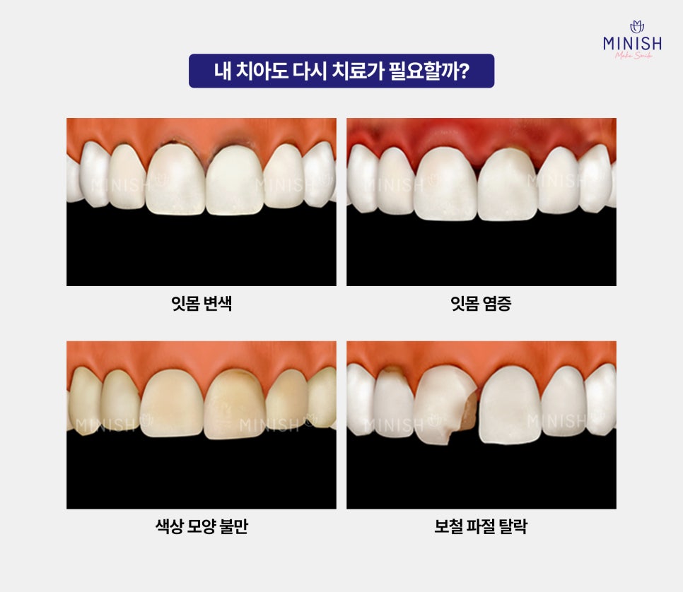 Laminates Retreatment: Be Sure to Know This Before You Proceed! image 2