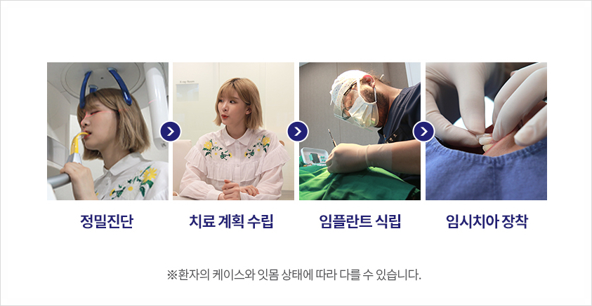 '임플란트'의 거의 모든 것 관련 이미지 10