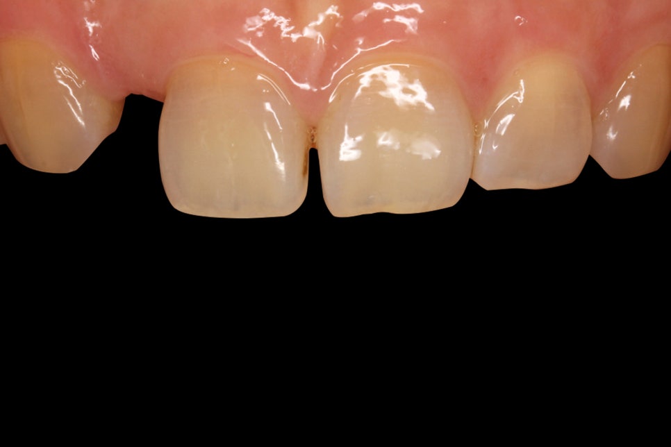 강남구청치과 건강한 아름다움, 미니쉬로 활짝 핀 자신감을 선물해 드립니다 관련 이미지 3