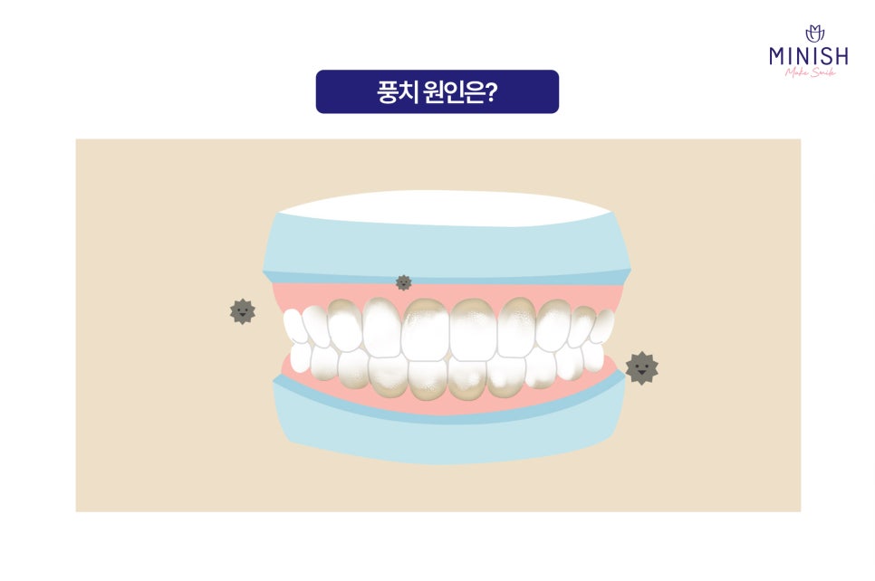 Swollen Gums and Bleeding? Warning Signs of Periodontal Disease image 3