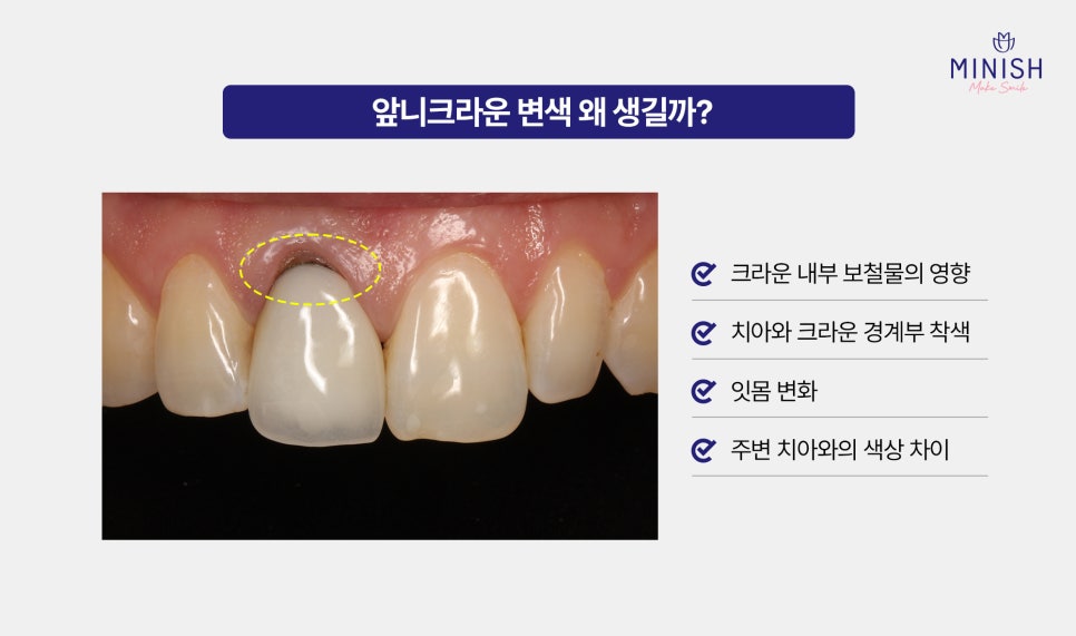 Should a Discolored Front Tooth Crown Be Replaced? Minish Revive for Retreatment image 2