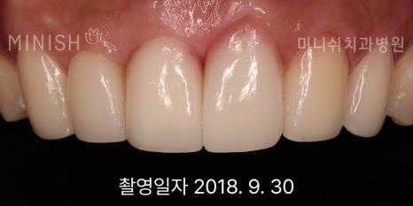 잇몸 내려앉음, 잇몸퇴축 원인과 치료 방법은? 관련 이미지 10