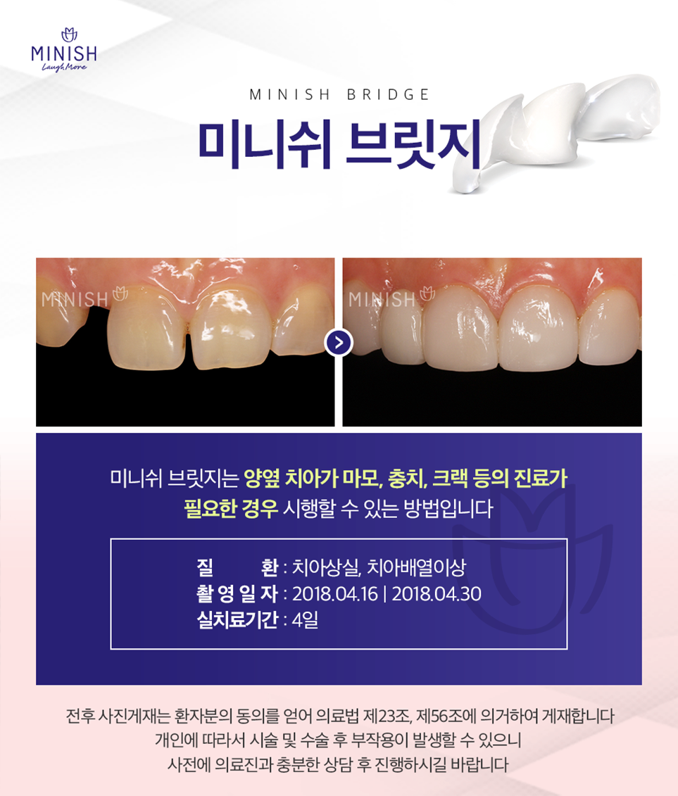 미니쉬솔루션 치아상실은 오래 방치하면 안되기에 관련 이미지 10
