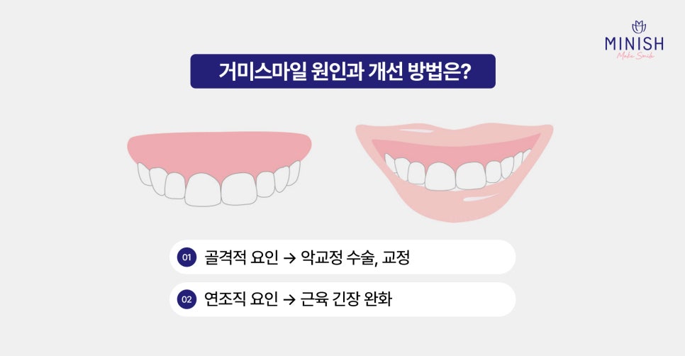 Gummy Smile: Why the Gums Show So Much When You Smile and How to Improve It image 3