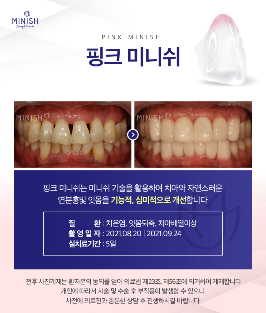 내려간 잇몸, 미니쉬로 아름다움을 되찾으세요 | 강남구청역치과 관련 이미지 3