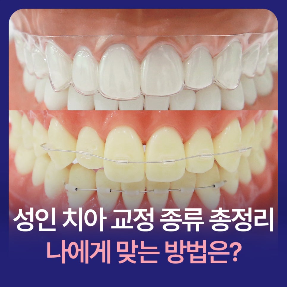 A Complete Guide to Adult Orthodontic Types: Which Method Is Right for Me? image 1
