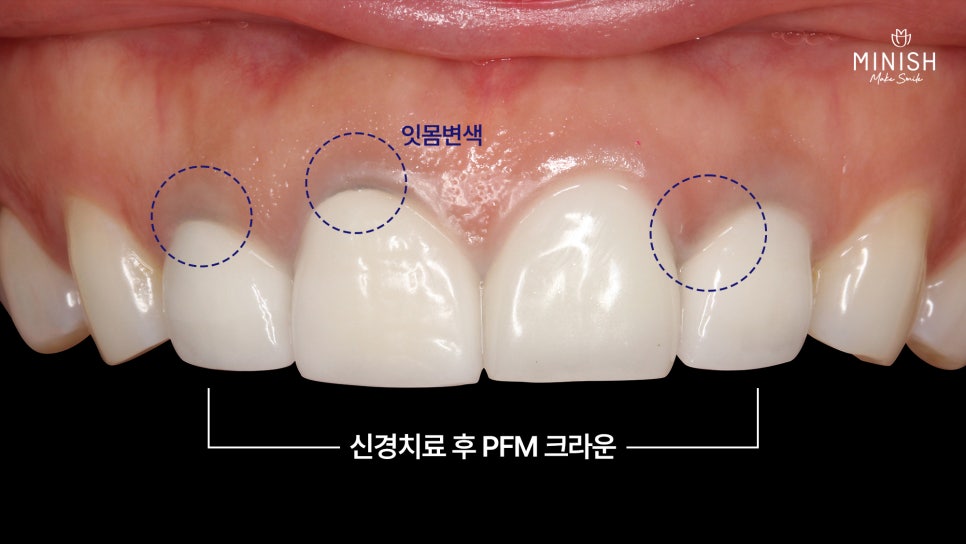앞니 크라운 재치료가 필요하다면? 미니쉬로 건강하게 복구하세요 관련 이미지 3