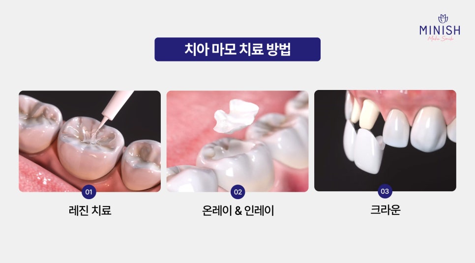 If You Leave Tooth Wear Untreated, It Becomes Irreversible. What Is the Solution? image 4