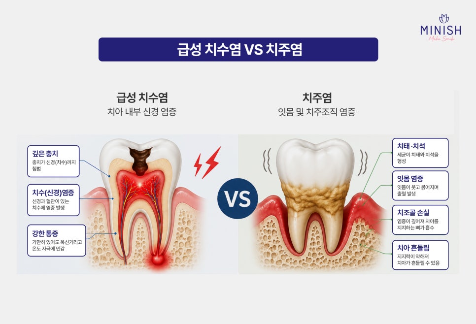 급성 치수염 VS 치주염 원인, 증상, 치료 방법까지 관련 이미지 6