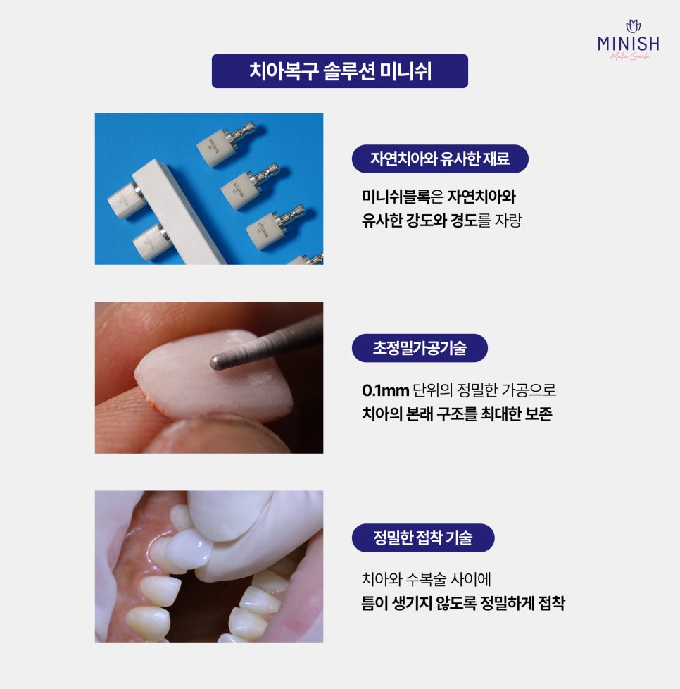 Regret It If You Leave Tooth Wear Untreated! What Are the Ways to Restore It Healthily? image 5