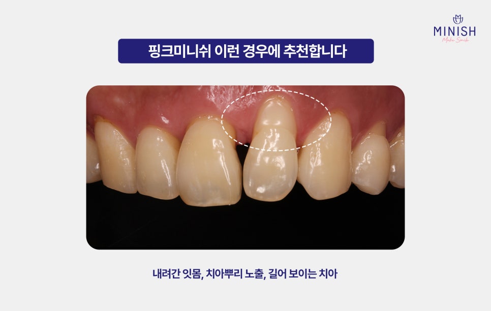 From Front Teeth to Molars, Which Minish Is Right for My Dental Condition? image 6