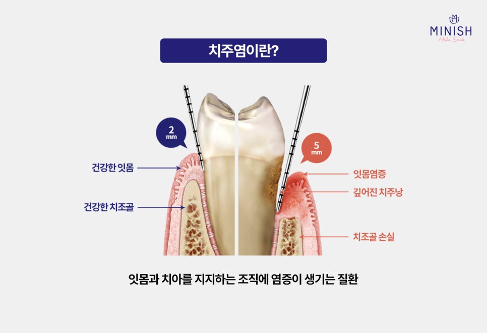 치주염 치료, 미니쉬가 제안하는 건강한 치아복구 솔루션 관련 이미지 2