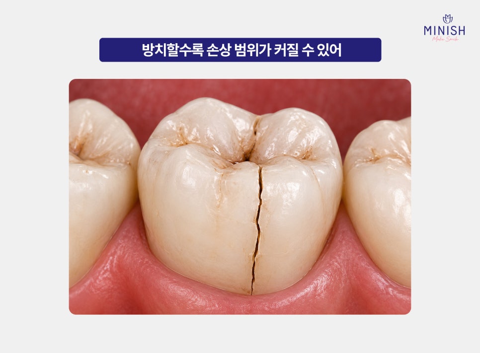 씹을때 어금니 통증 계속된다면 치아 균열 가능성도 의심 관련 이미지 3