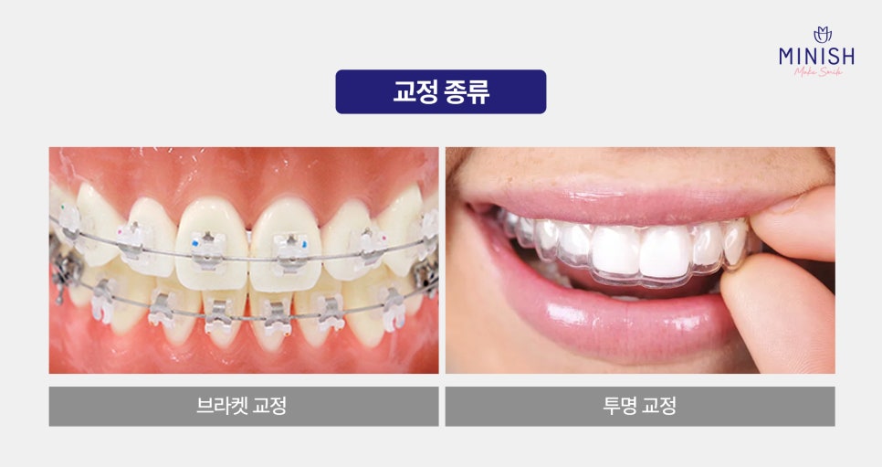 Worried About Orthodontics? Improve in One Day with Minish Harmony! image 3