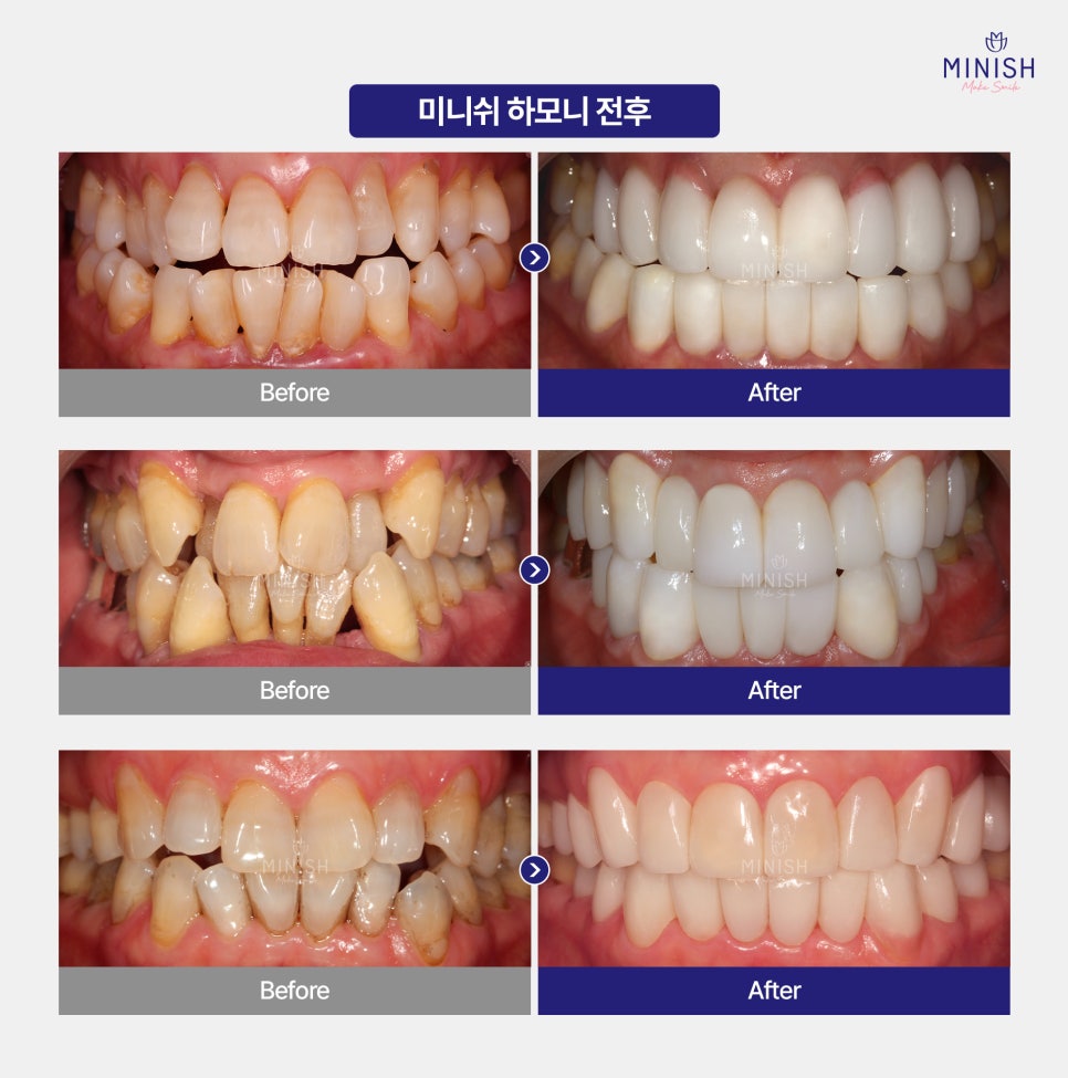 Crooked Teeth—Hesitating Because Orthodontic Treatment Might Take Too Long? Minish Harmony, Available in One Day image 5