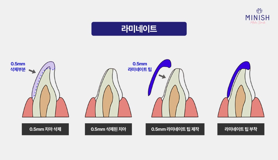 작은치아 왜소치 교정 가장 좋은 방법은? 관련 이미지 4
