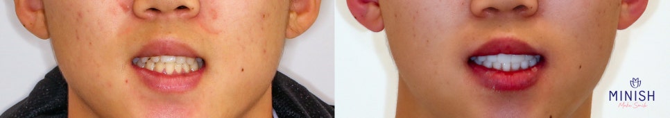 The front teeth I had worried about because of missing teeth, transformed healthily with MINISH image 4