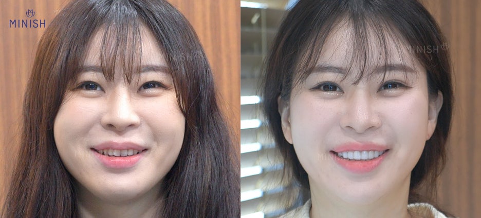 취업 방해하는 앞니덧니! 신사역치과에서 미니쉬로 해결 관련 이미지 2