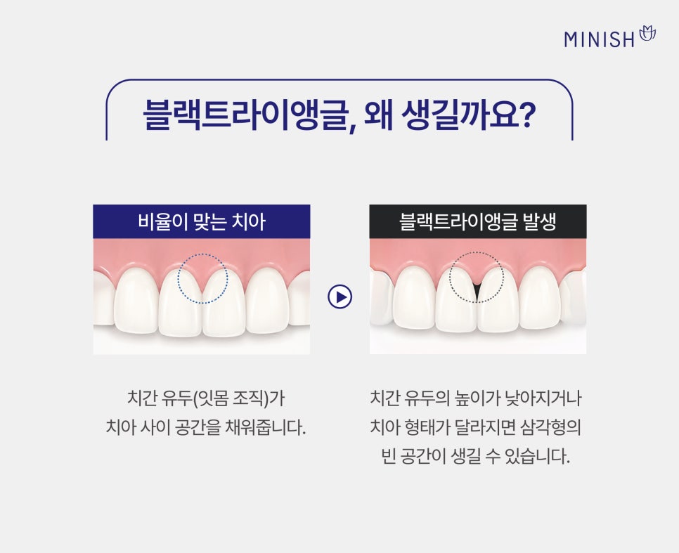 앞니 블랙트라이앵글 증상 원인, 레진 치료 한계와 미니쉬 관련 이미지 2