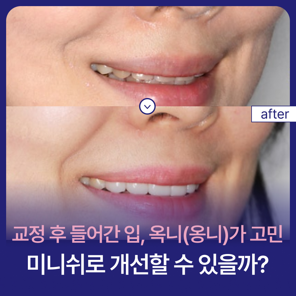 교정 후 들어간 입, 옥니 (옹니)가 고민, 미니쉬로 개선할 수 있을까? 관련 이미지 1