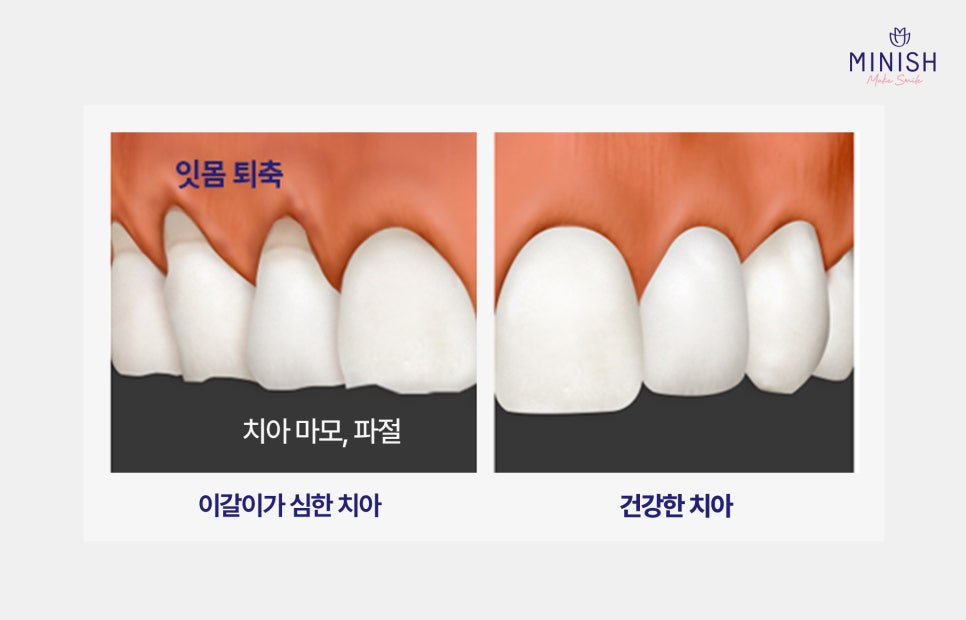 이갈이로 인한 치아마모, 미니쉬로 해결하세요! 관련 이미지 2