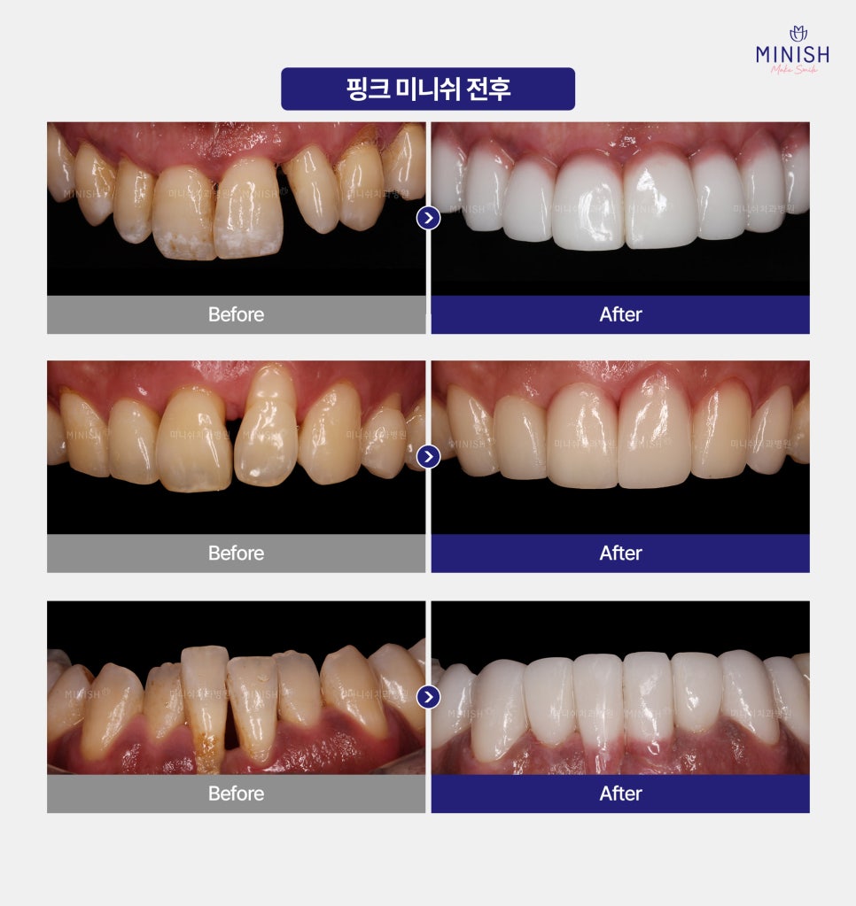 풍치치료 한계 잇몸내려앉음 핑크미니쉬로 해결! 관련 이미지 7