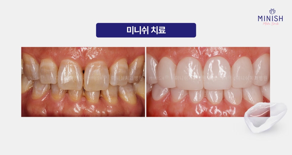 누런 치아? 치아변색 원인과 치료방법은? 관련 이미지 7