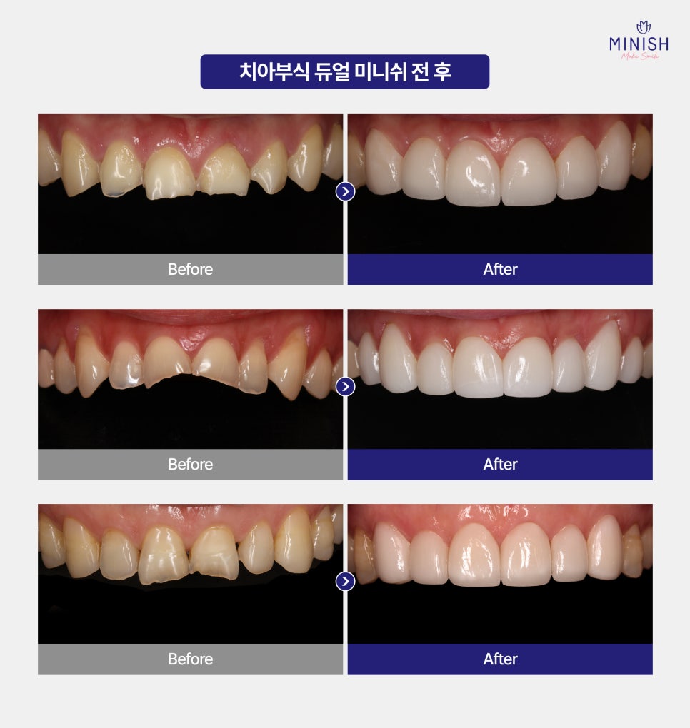 방치하면 큰일! 치아부식 증상 원인 치료 방법엔? 듀얼미니쉬 관련 이미지 6