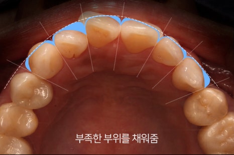 Is It Possible to Straighten Teeth in Just One Day? image 14