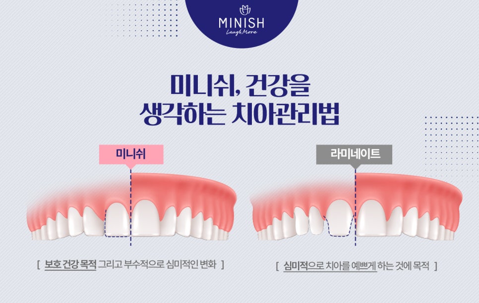 임시치아가 필요 없는 미니쉬 관련 이미지 2