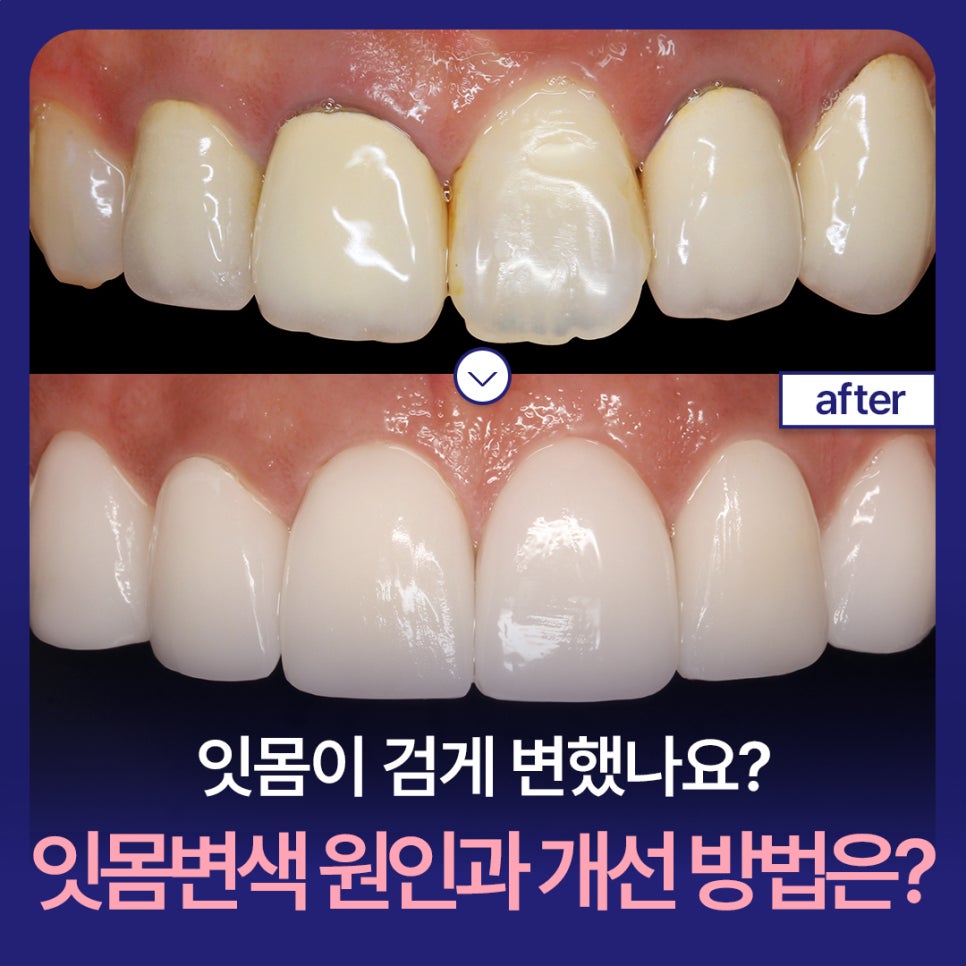 Have your gums turned dark? What causes gum discoloration, and how can it be improved? image 1