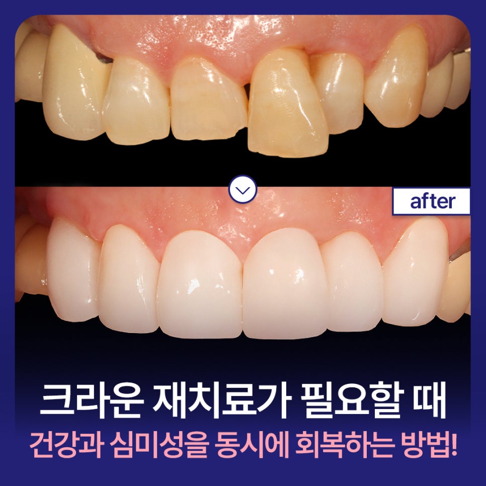 Protruding Front Teeth: How to Restore Both Health and Aesthetics When Crown Retreatment Is Needed! image 1