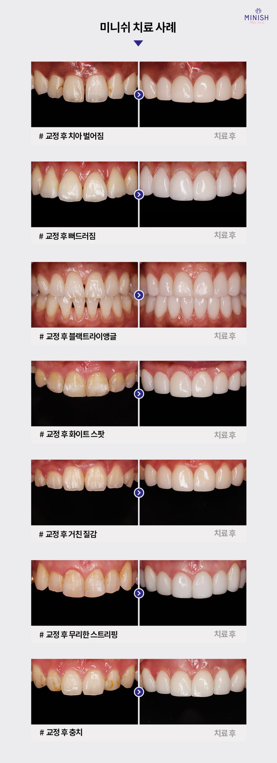 잘 보이지 않는 투명교정 하기 전에 알아두면 좋은 점 관련 이미지 7