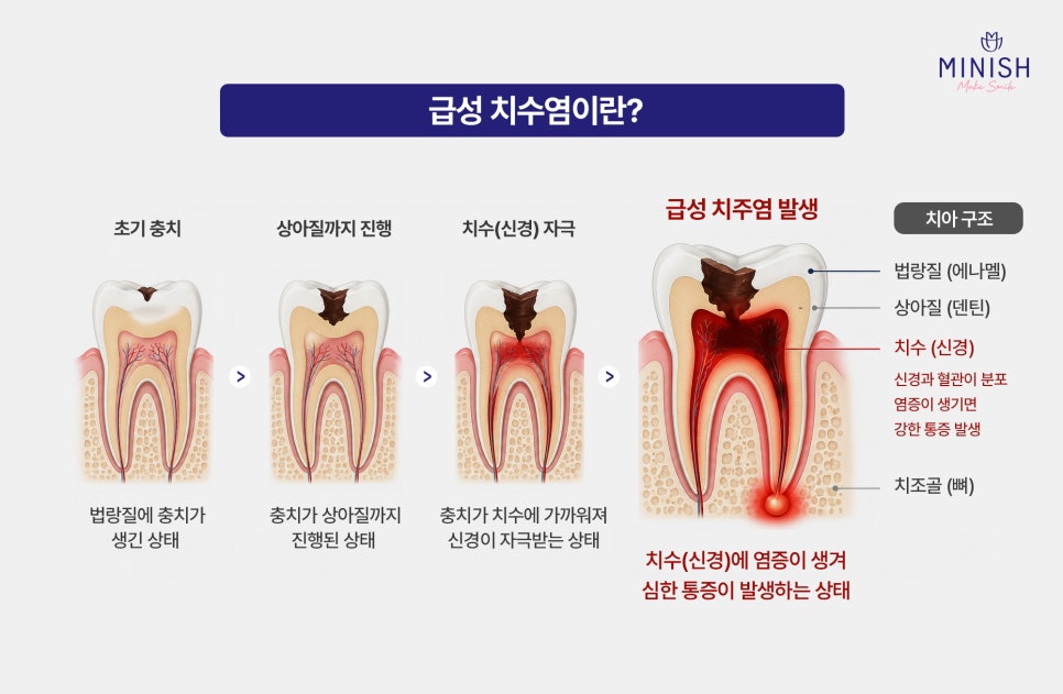 급성 치수염 VS 치주염 원인, 증상, 치료 방법까지 관련 이미지 2