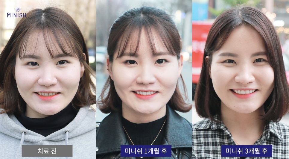 벌어진치아 교정은 미니쉬 잘하는 곳에서 미니쉬! 관련 이미지 6