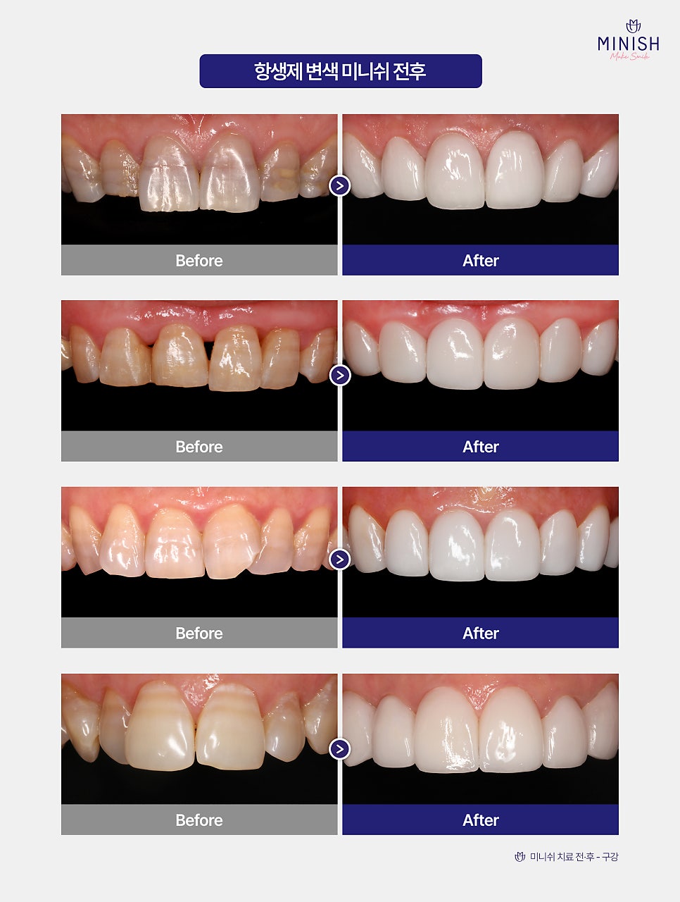 Antibiotic-Discolored Teeth Can Be Treated with MINISH! image 5