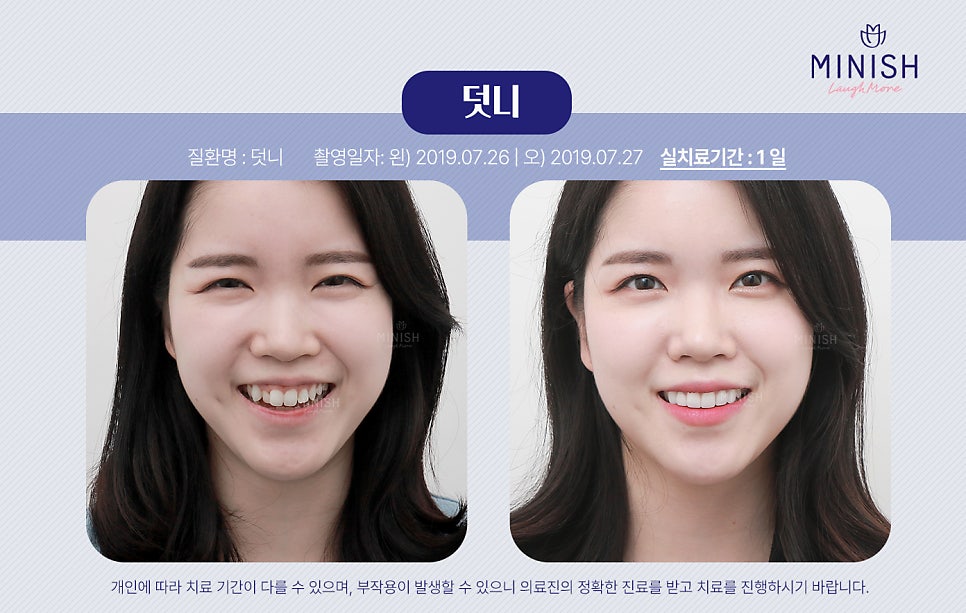 덧니교정, 왜 바로 잡아야 할까요? 관련 이미지 2