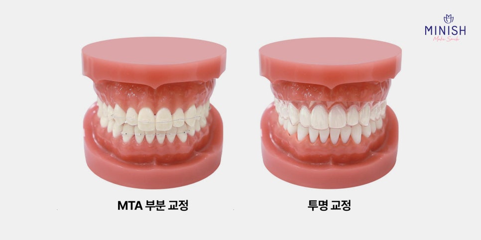 벌어진 앞니 치료 방법 세가지 장단점 관련 이미지 4