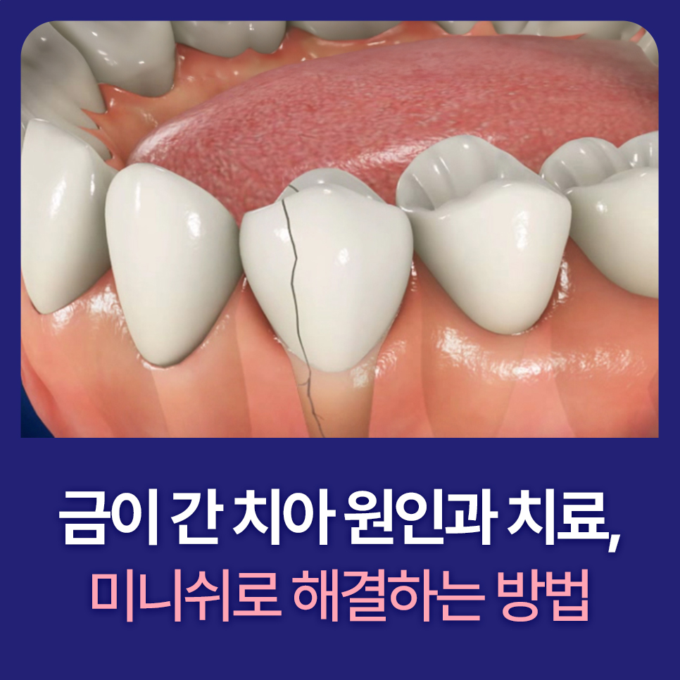 Cracked Teeth, from Cause to Treatment! How to Regain Healthy Teeth image 1