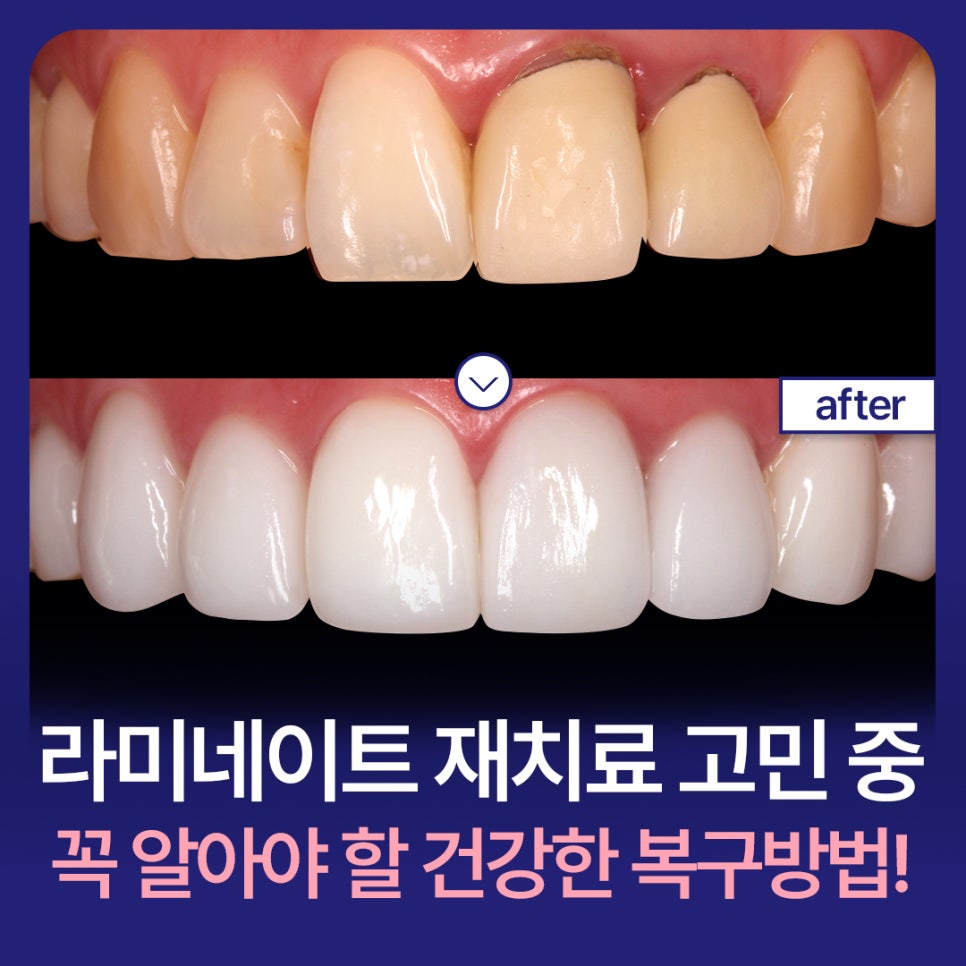 If You’re Considering Laminate Retreatment, Be Sure to Learn About the Side Effects and Healthy Restoration Methods! image 1