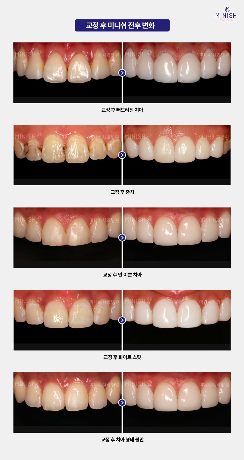 Types of Orthodontic Treatment at Minish Dental Hospital and How to Improve Aesthetics Too! image 8