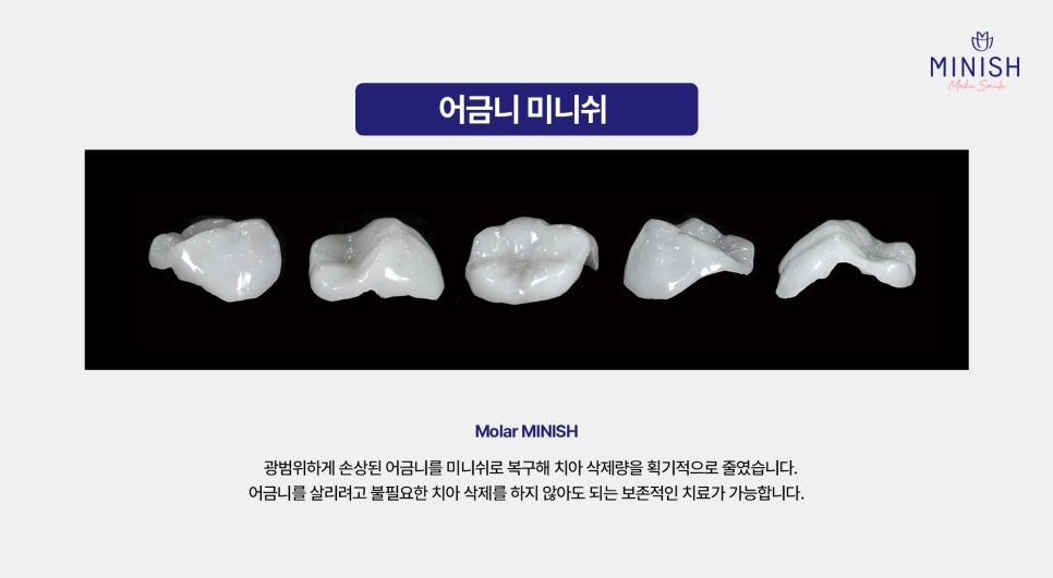 [Cracked Molar] Sudden Pain in Everyday Life, from Causes to Treatment Methods image 5