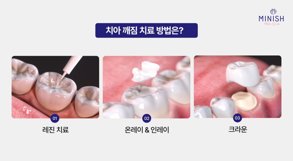 [Cracked Molar] Sudden Pain in Everyday Life, from Causes to Treatment Methods image 4