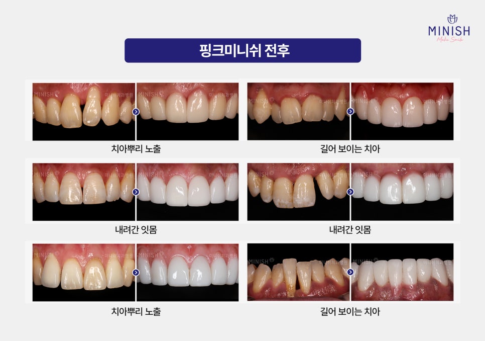 From Front Teeth to Molars, Which Minish Is Right for My Dental Condition? image 7