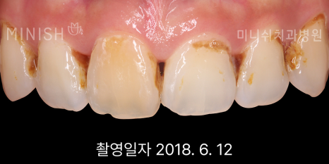 입냄새 원인 별 예방과 제거 치료 방법은? 관련 이미지 7