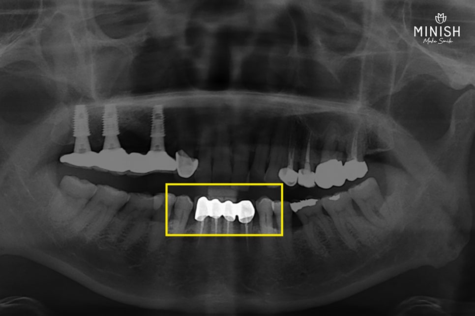Protruding Front Teeth: How to Restore Both Health and Aesthetics When Crown Retreatment Is Needed! image 4