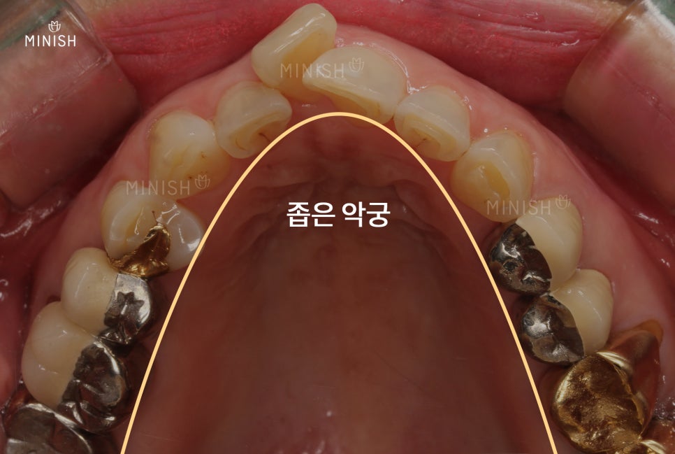 강남구치과, 앞니틀어짐을 갖고 있는 경우 나에게 맞는 치료법은? 관련 이미지 5